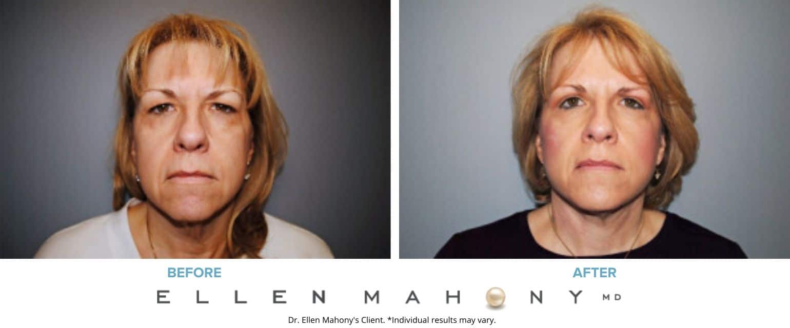 Before and After Image: Case #7574 - front