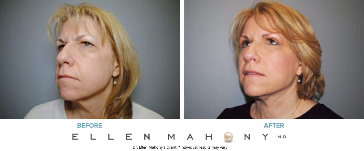 Before and After Image: Case #7574 - left-front-oblique