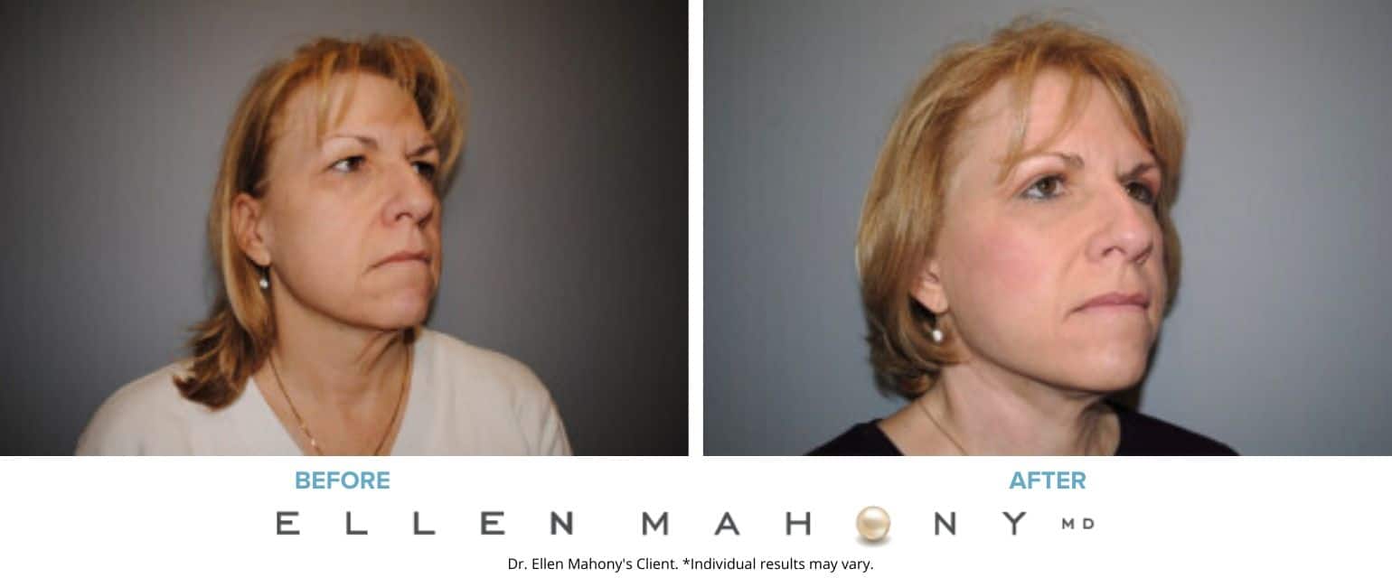 Before and After Image: Case #7574 - right-front-oblique