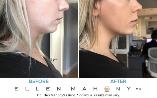 Before and After Image: Case #7578 - right-side