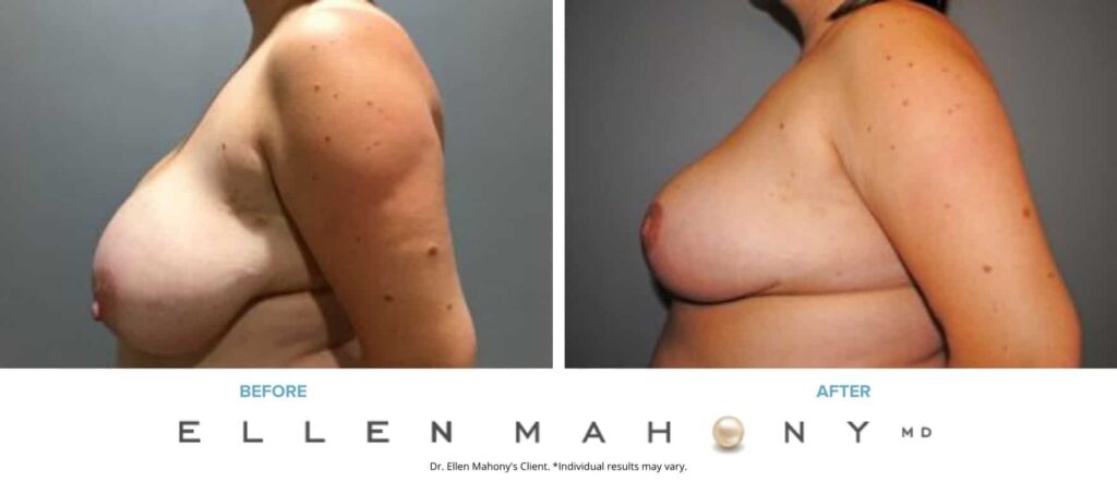 Before and After Image: Case #7671 - left-side