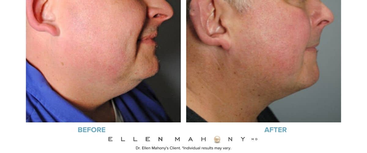 Before and After Image: Case #7677 - right-side