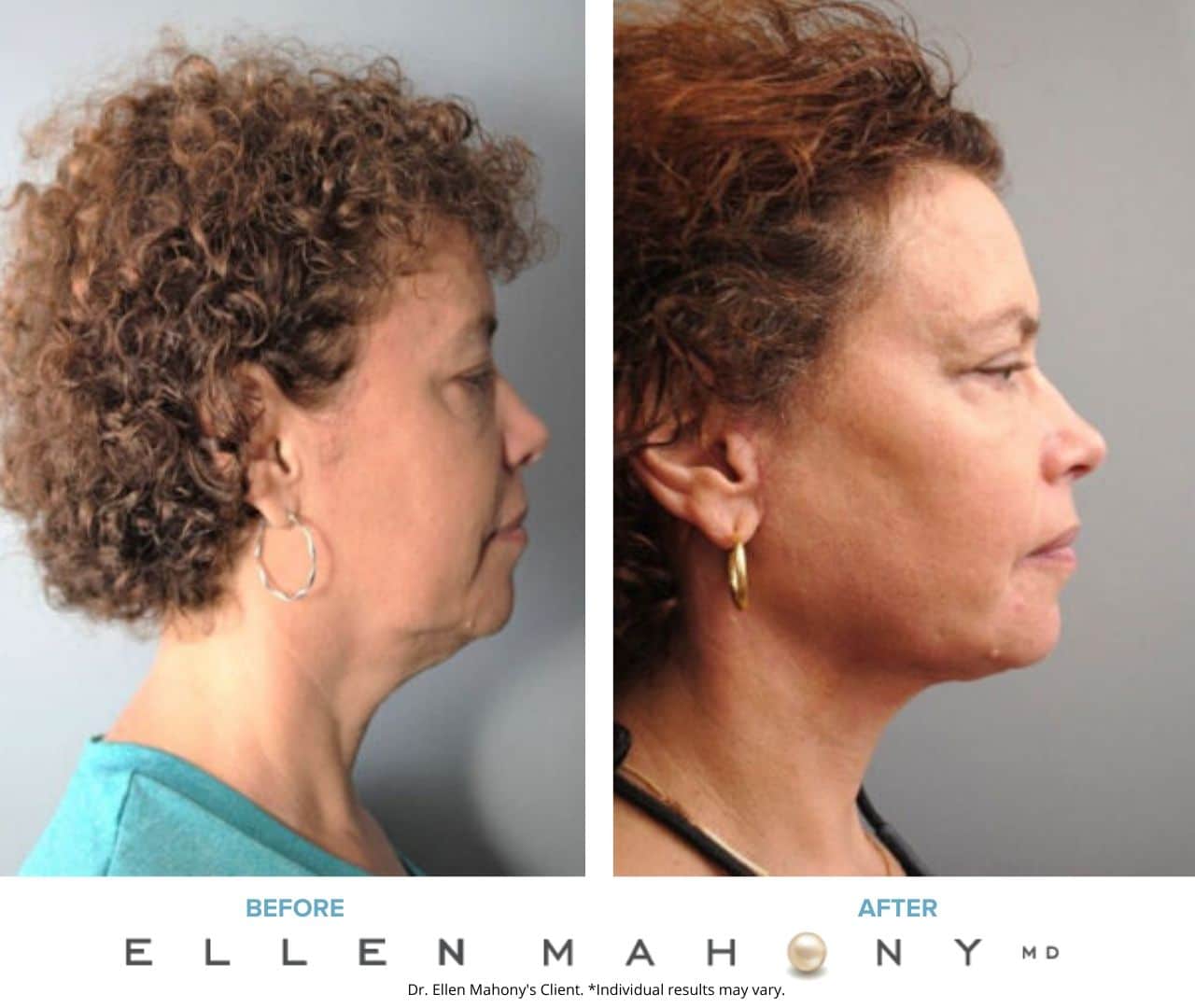 Before and After Image: Case #8222 - right-side