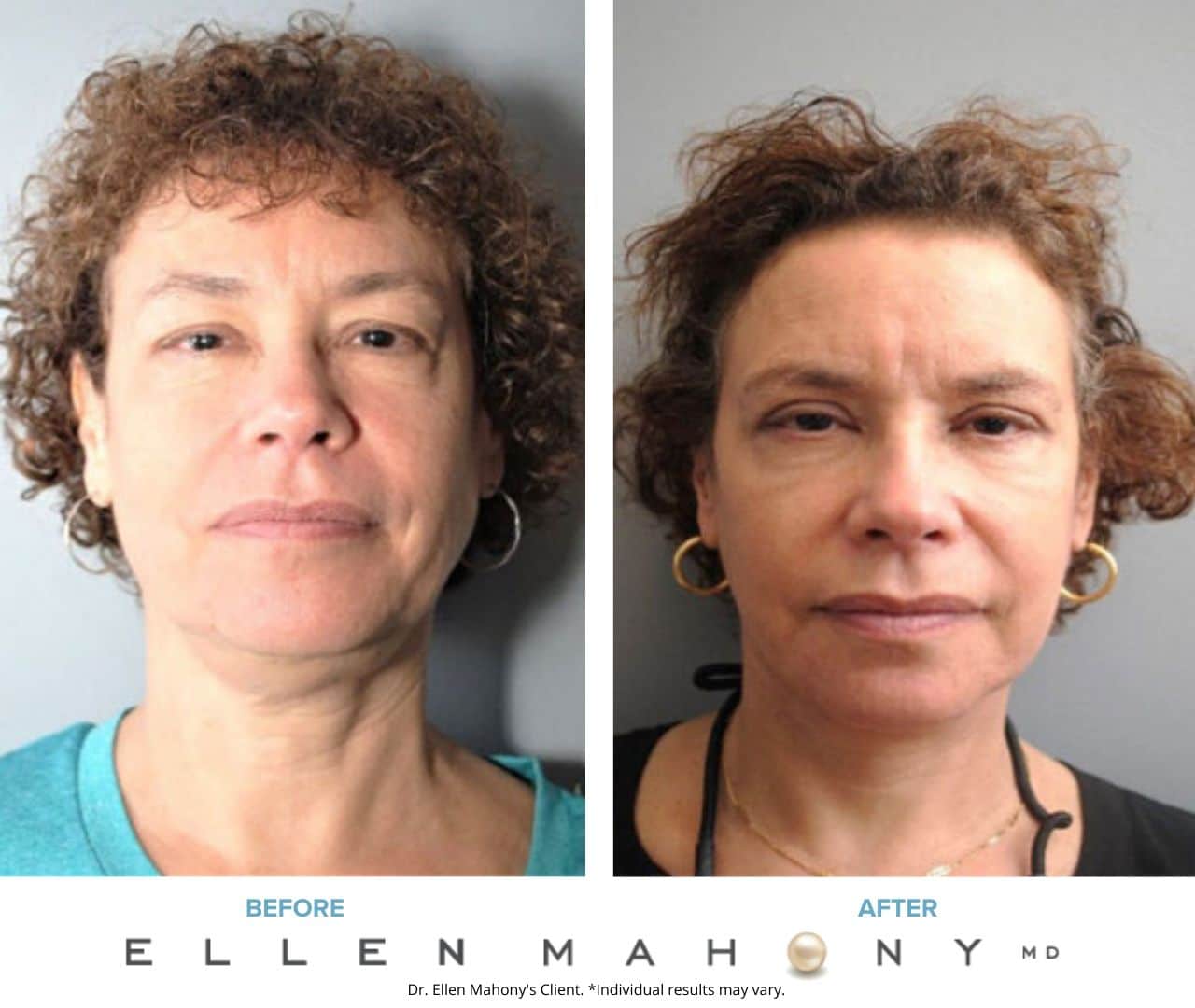Before and After Image: Case #8222 - front