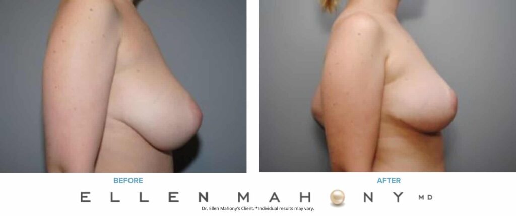 Before and After Image: Case #8281 - right-side