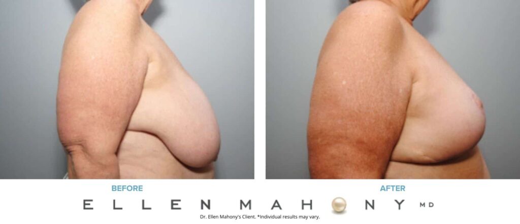 Before and After Image: Case #8348 - right-side