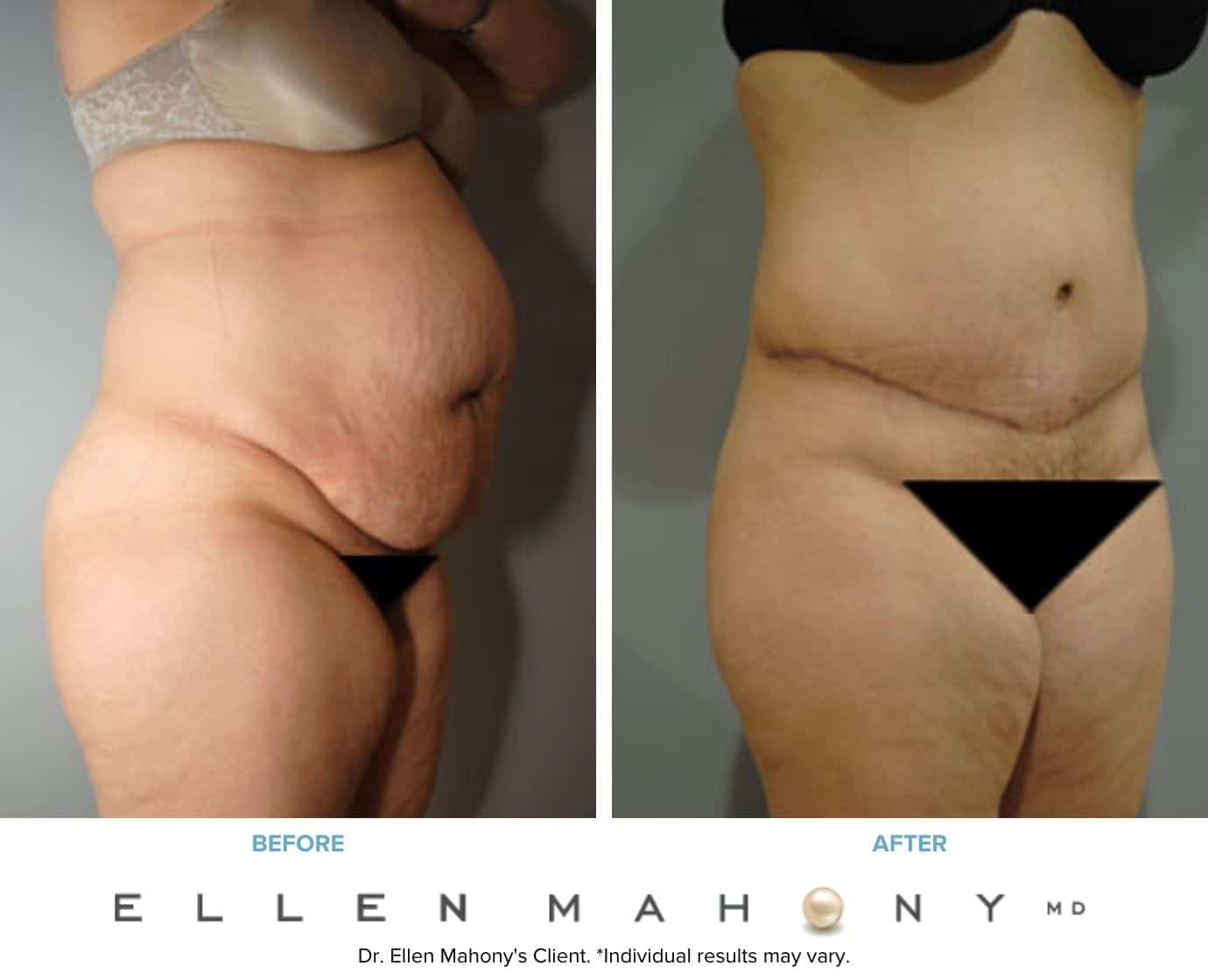 Before and After Image: Case #8501 - right-front-oblique