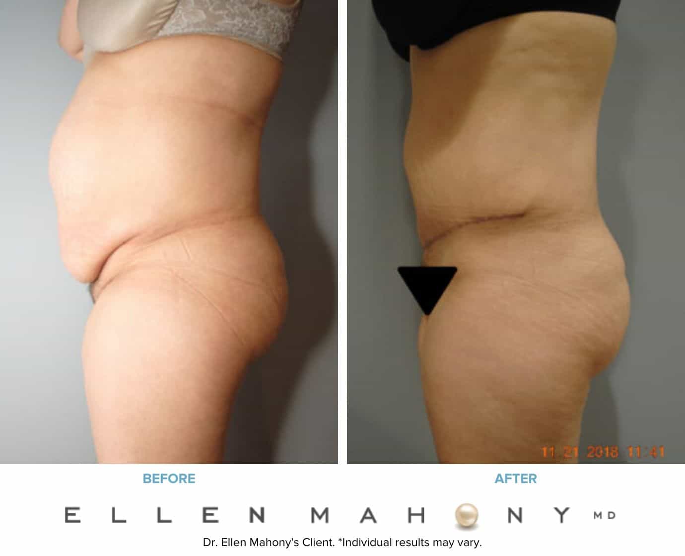 Before and After Image: Case #8501 - left-side