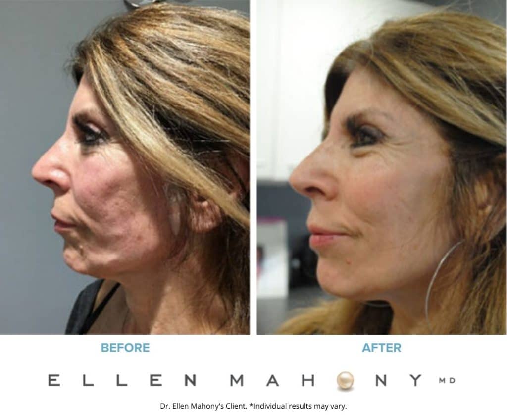 Before and After Image: Case #8546 - left-side