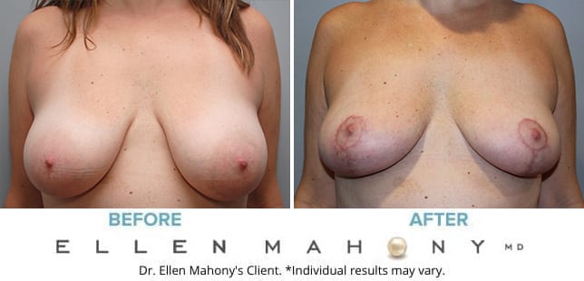 Before and After Image: Case #10039 - front