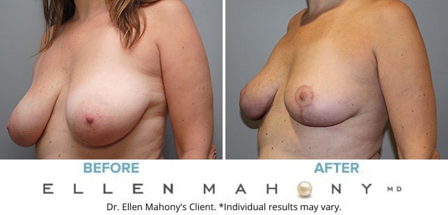 Before and After Image: Case #10039 - left-front-oblique