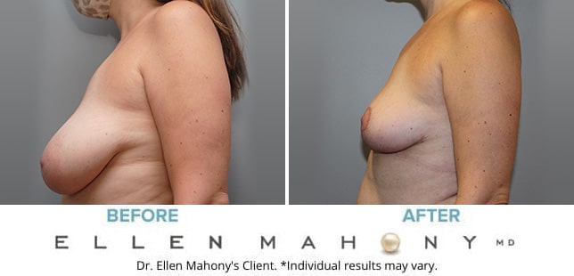 Before and After Image: Case #10039 - left-side