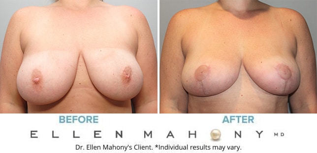 Before and After Image: Case #10098 - front