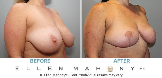 Before and After Image: Case #10098 - right-front-oblique