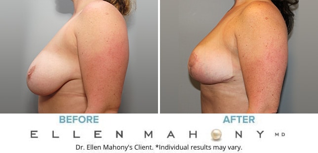 Before and After Image: Case #10098 - left-side
