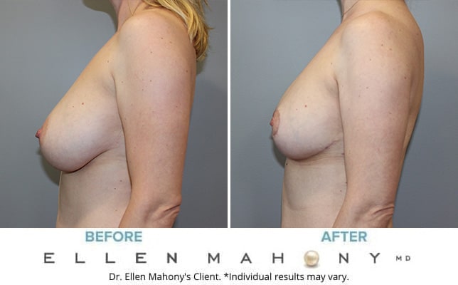 Before and After Image: Case #10528 - left-side