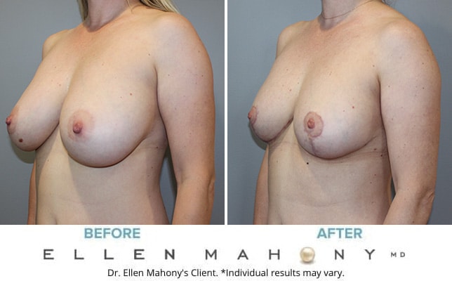 Before and After Image: Case #10528 - left-front-oblique