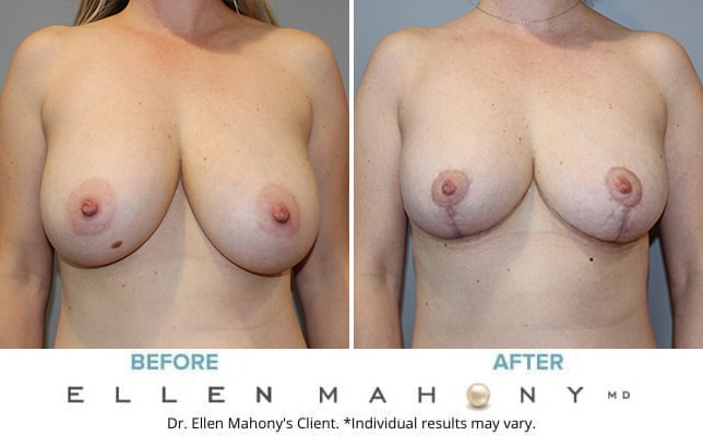 Before and After Image: Case #10528 - front