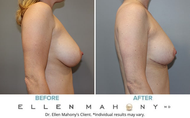 Before and After Image: Case #10528 - right-side