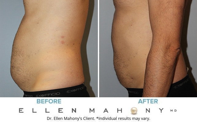 Before and After Image: Case #10588 - left-side
