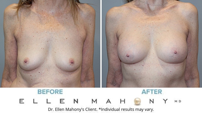 Before and After Image: Case #10645 - front