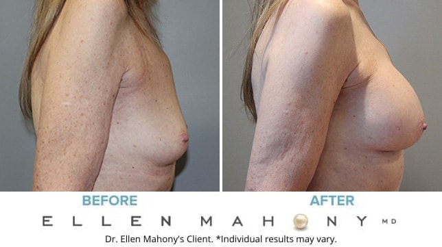 Before and After Image: Case #10645 - right-side