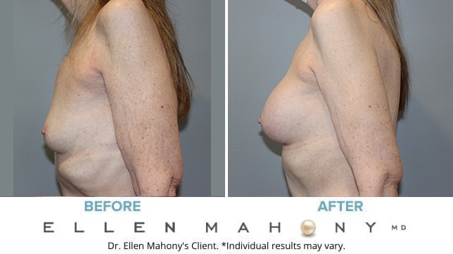 Before and After Image: Case #10645 - left-side