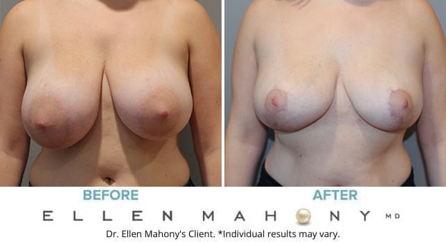 Before and After Image: Case #10783 - front