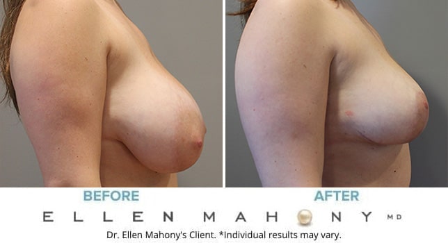 Before and After Image: Case #10783 - right-side