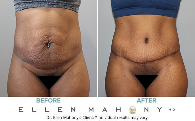Before and After Image: Case #10803 - front