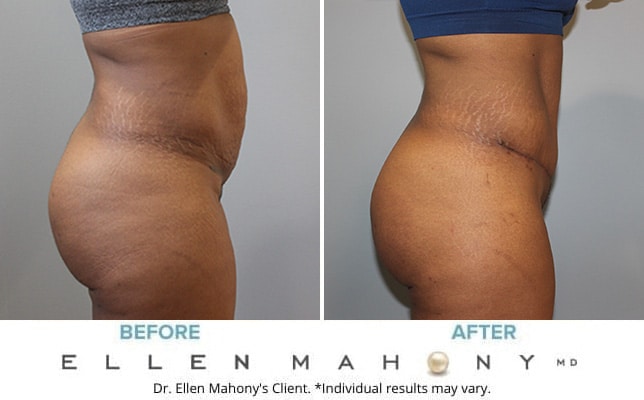 Before and After Image: Case #10803 - right-side