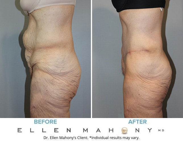 Before and After Image: Case #122 - left-side