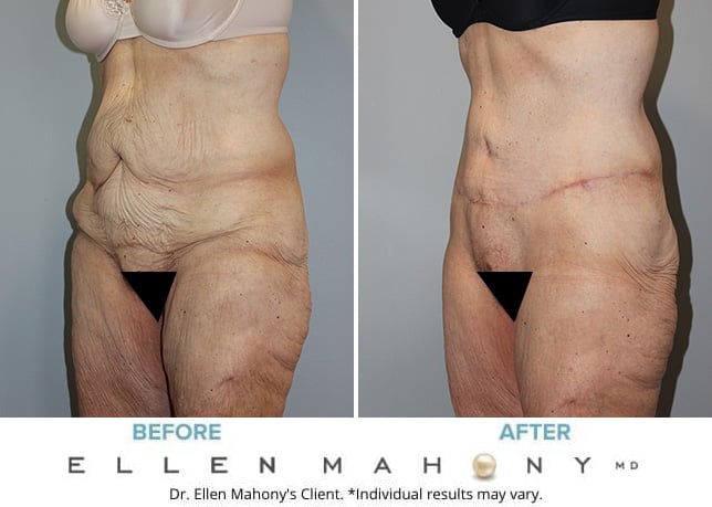 Before and After Image: Case #122 - left-front-oblique