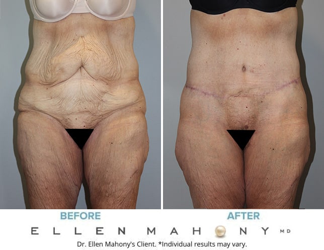Before and After Image: Case #122 - front