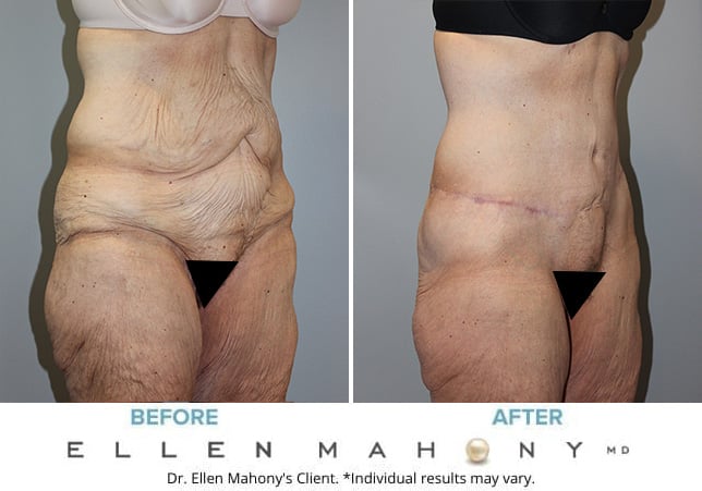 Before and After Image: Case #122 - right-front-oblique