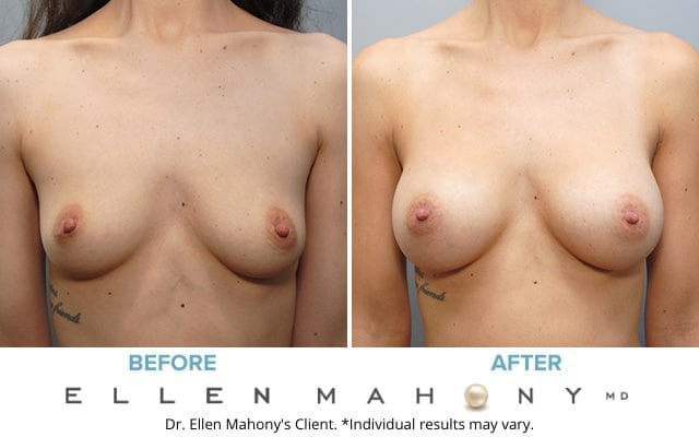 Before and After Image: Case #7050 - front