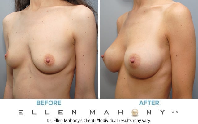 Before and After Image: Case #7050 - left-front-oblique