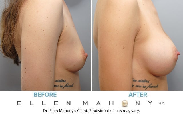 Before and After Image: Case #7050 - right-side