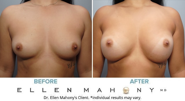 Before and After Image: Case #7067 - front