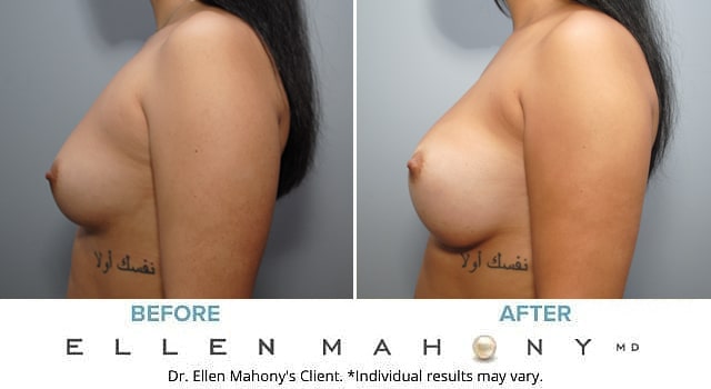 Before and After Image: Case #7067 - left-side