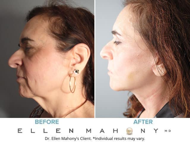 Before and After Image: Case #8225 - left-side