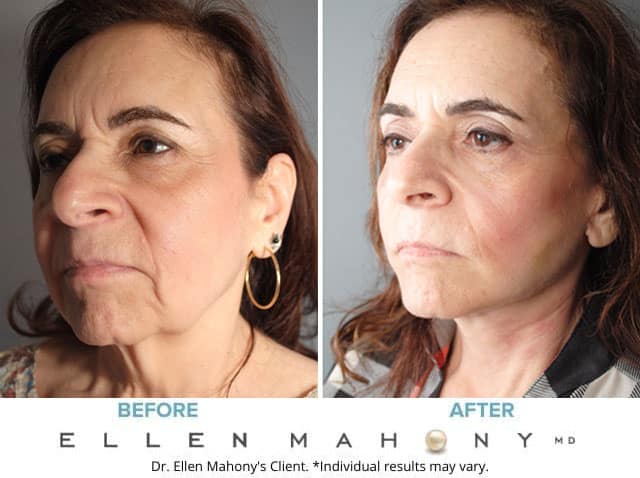 Before and After Image: Case #8225 - left-front-oblique