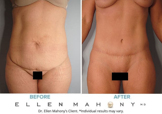 Before and After Image: Case #8255 - front