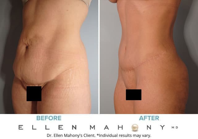 Before and After Image: Case #8255 - left-front-oblique