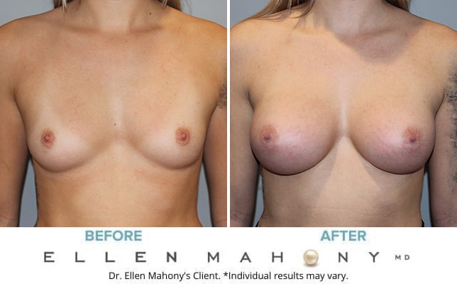 Before and After Image: Case #8342 - front
