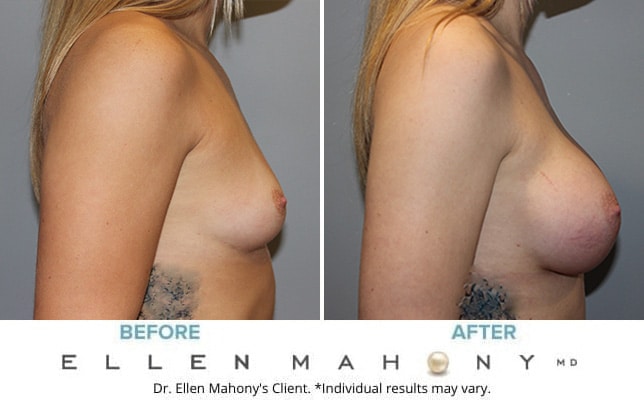 Before and After Image: Case #8342 - right-side