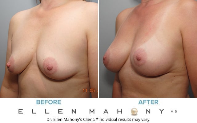 Before and After Image: Case #8609 - left-front-oblique