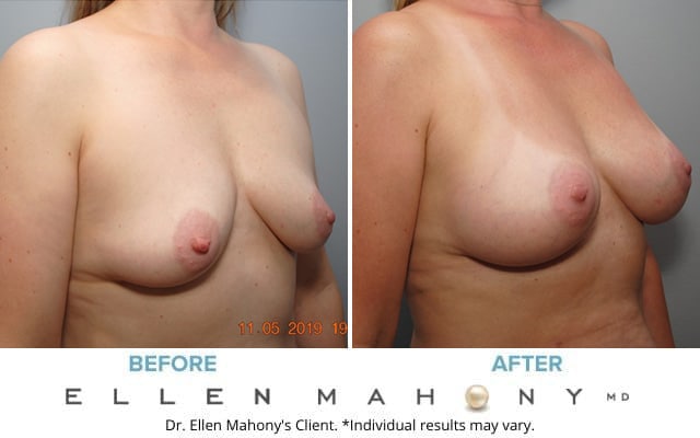 Before and After Image: Case #8609 - right-front-oblique