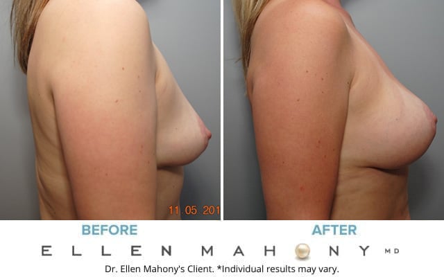 Before and After Image: Case #8609 - right-side