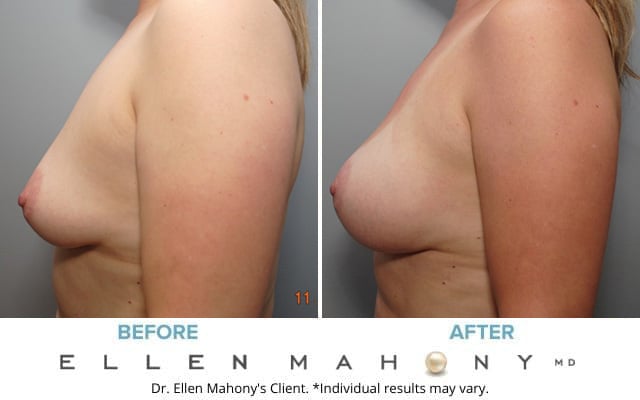 Before and After Image: Case #8609 - left-side